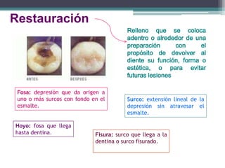 Restauración
Relleno que se coloca
adentro o alrededor de una
preparación
con
el
propósito de devolver al
diente su función, forma o
estética, o para evitar
futuras lesiones
Fosa: depresión que da origen a
uno o más surcos con fondo en el
esmalte.
Hoyo: fosa que llega
hasta dentina.

Surco: extensión lineal de la
depresión sin atravesar el
esmalte.

Fisura: surco que llega a la
dentina o surco fisurado.

 