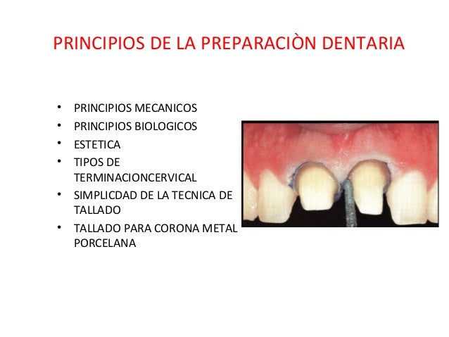 Principios de tallado dental 3