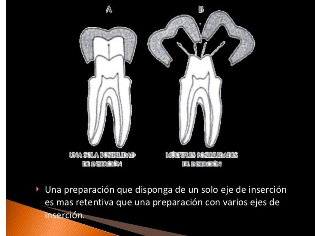 Principios de tallado dental 3