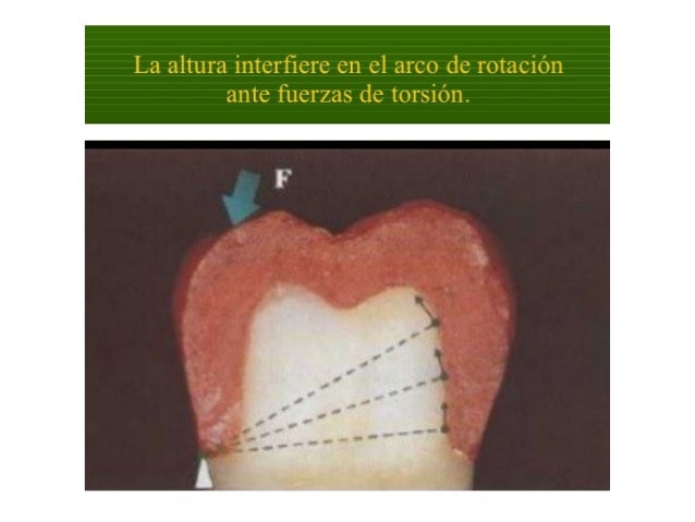 Principios de tallado dental 3