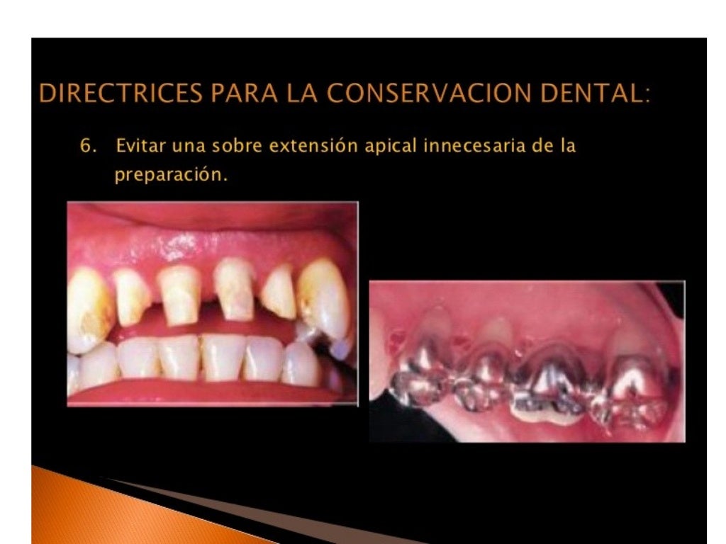 Principios de tallado dental 3