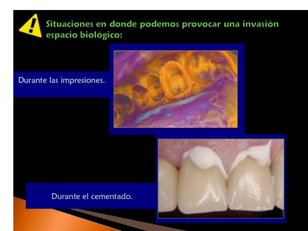 Principios de tallado dental 3