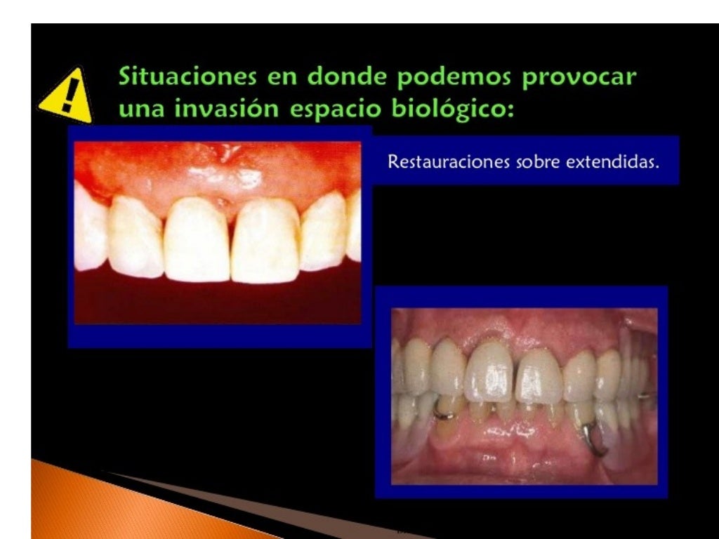 Principios de tallado dental 3