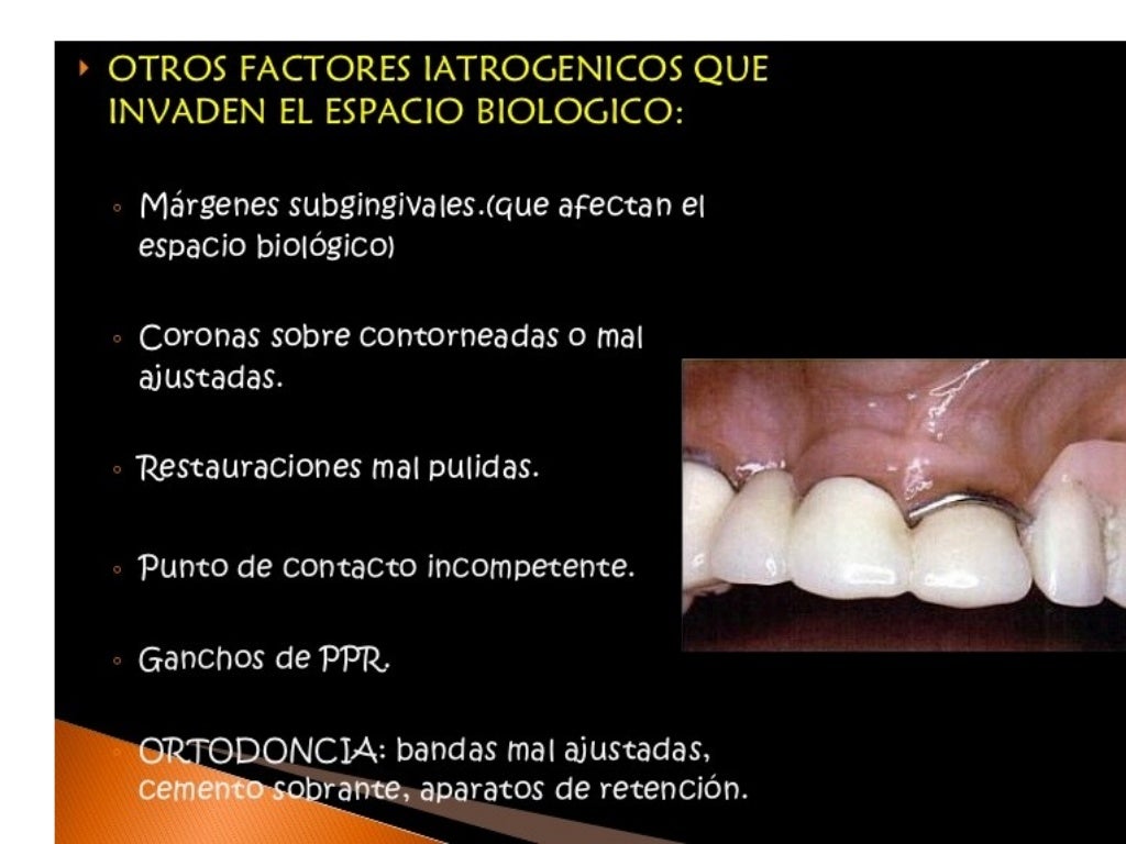 Principios de tallado dental 3