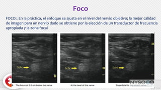 FOCO:. En la práctica, el enfoque se ajusta en el nivel del nervio objetivo; la mejor calidad
de imagen para un nervio dado se obtiene por la elección de un transductor de frecuencia
apropiada y la zona focal
Foco
 