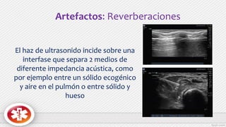 Artefactos: Reverberaciones
El haz de ultrasonido incide sobre una
interfase que separa 2 medios de
diferente impedancia acústica, como
por ejemplo entre un sólido ecogénico
y aire en el pulmón o entre sólido y
hueso
 