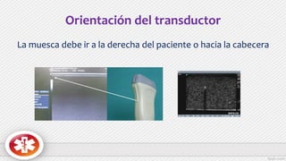 Orientación del transductor
La muesca debe ir a la derecha del paciente o hacia la cabecera
 