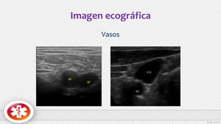 Imagen ecográfica
Vasos
 