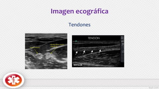 Imagen ecográfica
Tendones
 