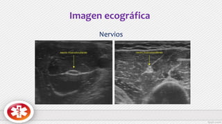 Imagen ecográfica
Nervios
 