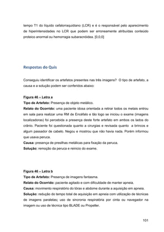101
tempo T1 do líquido cefalorraquidiano (LCR) e é o responsável pelo aparecimento
de hiperintensidades no LCR que podem ser erroneamente atribuídas conteúdo
proteico anormal ou hemorragia subaracnóidea. [0,0,0]
Respostas	
  do	
  Quis	
  
Conseguiu identificar os artefatos presentes nas três imagens? O tipo de artefato, a
causa e a solução podem ser conferidos abaixo:
Figura 46 – Letra a
Tipo de Artefato: Presença de objeto metálico.
Relato do Ocorrido: uma paciente idosa orientada a retirar todos os metais entrou
em sala para realizar uma RM de Encéfalo e tão logo se iniciou o exame (imagens
localizadoras) foi percebida a presença deste forte artefato em ambos os lados do
crânio. Paciente foi questionada quanto a cirurgias e revisada quanto a brincos e
algum passador de cabelo. Negou e mostrou que não havia nada. Porém informou
que usava peruca.
Causa: presença de presilhas metálicas para fixação da peruca.
Solução: remoção da peruca e reinicio do exame.
Figura 46 – Letra b
Tipo de Artefato: Presença de imagens fantasma.
Relato do Ocorrido: paciente agitado e com dificuldade de manter apneia.
Causa: movimento respiratório do tórax e abdome durante a aquisição em apneia.
Solução: redução do tempo total de aquisição em apneia com utilização de técnicas
de imagens paralelas; uso de sincronia respiratória por cinta ou navegador na
imagem ou uso de técnica tipo BLADE ou Propeller.
 