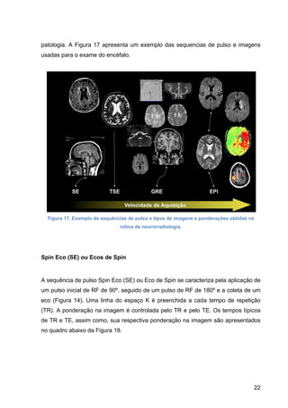 22
patologia. A Figura 17 apresenta um exemplo das sequencias de pulso e imagens
usadas para o exame do encéfalo.
Figura 17. Exemplo de sequências de pulso e tipos de imagens e ponderações obtidas na
rotina de neurorradiologia.
Spin Eco (SE) ou Ecos de Spin
A sequência de pulso Spin Eco (SE) ou Eco de Spin se caracteriza pela aplicação de
um pulso inicial de RF de 90º, seguido de um pulso de RF de 180º e a coleta de um
eco (Figura 14). Uma linha do espaço K é preenchida a cada tempo de repetição
(TR). A ponderação na imagem é controlada pelo TR e pelo TE. Os tempos típicos
de TR e TE, assim como, sua respectiva ponderação na imagem são apresentados
no quadro abaixo da Figura 18.
 