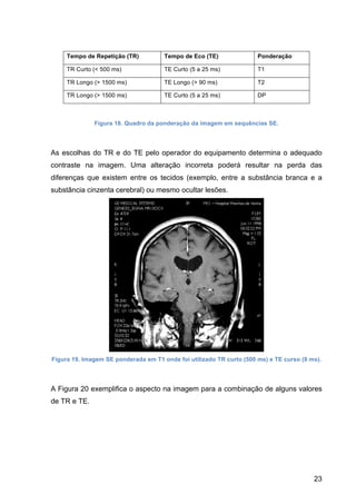 23
Tempo de Repetição (TR) Tempo de Eco (TE) Ponderação
TR Curto (< 500 ms) TE Curto (5 a 25 ms) T1
TR Longo (> 1500 ms) TE Longo (> 90 ms) T2
TR Longo (> 1500 ms) TE Curto (5 a 25 ms) DP
Figura 18. Quadro da ponderação da imagem em sequências SE.
As escolhas do TR e do TE pelo operador do equipamento determina o adequado
contraste na imagem. Uma alteração incorreta poderá resultar na perda das
diferenças que existem entre os tecidos (exemplo, entre a substância branca e a
substância cinzenta cerebral) ou mesmo ocultar lesões.
Figura 19. Imagem SE ponderada em T1 onde foi utilizado TR curto (500 ms) e TE curso (9 ms).
A Figura 20 exemplifica o aspecto na imagem para a combinação de alguns valores
de TR e TE.
 