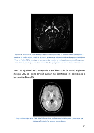 30
Figura 25. Imagem 3D com utilização da técnica de projeção de máxima intensidade (MIP) a
partir de 90 cortes axiais como os da figura anterior de uma angiografia de crânio baseada em
Time-of-Flight (TOF). Este tipo de apresentação permite ao radiologista uma identificação de
aneurismas, obstruções e outras anormalidades que podem ocorrer na anatomia vascular.
Sendo as aquisições GRE susceptíveis a alterações locais do campo magnético,
imagens GRE do tecido cerebral auxiliam na identificação de calcificações e
hemorragias (Figura 26).
Figura 26. Imagem axial GRE do tecido cerebral onde é possível visualizar como áreas de
hipossinal (escuras) o sangue hemorrágico.
 