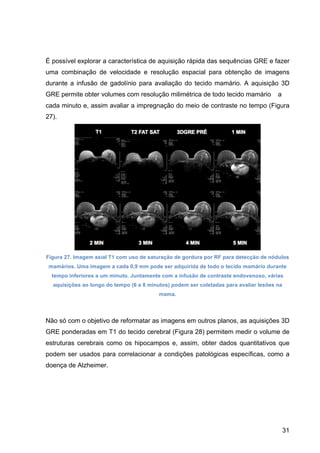 31
É possível explorar a característica de aquisição rápida das sequências GRE e fazer
uma combinação de velocidade e resolução espacial para obtenção de imagens
durante a infusão de gadolínio para avaliação do tecido mamário. A aquisição 3D
GRE permite obter volumes com resolução milimétrica de todo tecido mamário a
cada minuto e, assim avaliar a impregnação do meio de contraste no tempo (Figura
27).
Figura 27. Imagem axial T1 com uso de saturação de gordura por RF para detecção de nódulos
mamários. Uma imagem a cada 0,9 mm pode ser adquirida de todo o tecido mamário durante
tempo inferiores a um minuto. Juntamente com a infusão de contraste endovenoso, várias
aquisições ao longo do tempo (6 a 8 minutos) podem ser coletadas para avaliar lesões na
mama.
Não só com o objetivo de reformatar as imagens em outros planos, as aquisições 3D
GRE ponderadas em T1 do tecido cerebral (Figura 28) permitem medir o volume de
estruturas cerebrais como os hipocampos e, assim, obter dados quantitativos que
podem ser usados para correlacionar a condições patológicas específicas, como a
doença de Alzheimer.
 