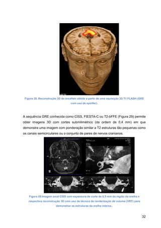 32
Figura 28. Reconstrução 3D do encéfalo obtida a partir de uma aquisição 3D T1 FLASH (GRE
com uso de spoiller).
A sequência GRE conhecida como CISS, FIESTA-C ou T2-bFFE (Figura 29) permite
obter imagens 3D com cortes submilimétrico (da ordem de 0,4 mm) em que
demonstra uma imagem com ponderação similar a T2 estruturas tão pequenas como
os canais semicirculares ou o conjunto de pares de nervos cranianos.
Figura 29.Imagem axial CISS com espessura de corte de 0,5 mm da região da orelha e
respectiva reconstrução 3D com uso de técnica de renderização de volume (VRT) para
demonstrar as estruturas da orelha interna..
 