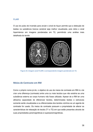 38
FLAIR
O uso do pulso de inversão para anular o sinal do líquor permite que a detecção de
lesões na substância branca cerebral seja melhor visualizada, pois retira o sinal
hiperintenso em imagens ponderadas em T2, permitindo uma análise mais
detalhada do tecido.
Figura 34. Imagem axial FLAIR e correspondente imagem ponderada em T2.
Meios	
  de	
  Contraste	
  em	
  RM	
  
Como o próprio nome já diz, o objetivo do uso de meios de contraste em RM é o de
criar uma diferença (contraste) entre uma ou mais tecidos que não existiria se uma
substância externa ao corpo humano não fosse utilizada. Apesar de a RM ter uma
altíssima capacidade de diferenciar tecidos, determinadas lesões e estruturas
somente serão visualizadas e ou diferenciadas dos tecidos vizinhos se um agente de
contraste for usado. Os meios de contraste possuem a propriedade de alterar as
características de relaxação do tecido (T1 e T2) em que estão presentes através de
suas propriedades paramagnéticas e superparamagnéticas.
 
