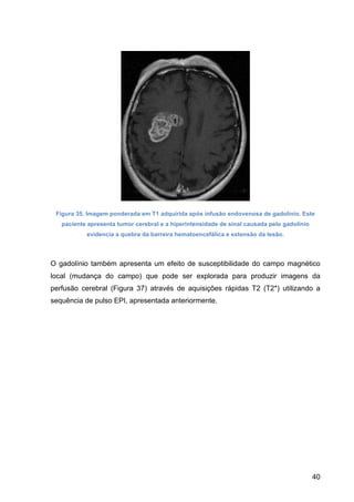 40
Figura 35. Imagem ponderada em T1 adquirida após infusão endovenosa de gadolínio. Este
paciente apresenta tumor cerebral e a hiperintensidade de sinal causada pelo gadolínio
evidencia a quebra da barreira hematoencefálica e extensão da lesão.
O gadolínio também apresenta um efeito de susceptibilidade do campo magnético
local (mudança do campo) que pode ser explorada para produzir imagens da
perfusão cerebral (Figura 37) através de aquisições rápidas T2 (T2*) utilizando a
sequência de pulso EPI, apresentada anteriormente.
 