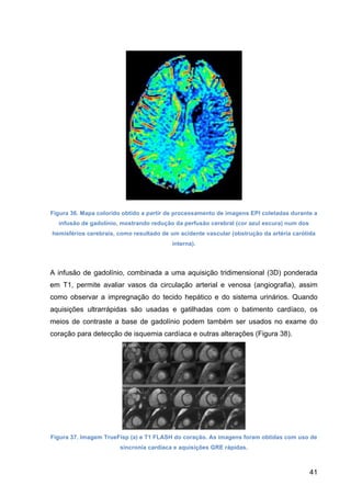 41
Figura 36. Mapa colorido obtido a partir de processamento de imagens EPI coletadas durante a
infusão de gadolínio, mostrando redução da perfusão cerebral (cor azul escura) num dos
hemisférios cerebrais, como resultado de um acidente vascular (obstrução da artéria carótida
interna).
A infusão de gadolínio, combinada a uma aquisição tridimensional (3D) ponderada
em T1, permite avaliar vasos da circulação arterial e venosa (angiografia), assim
como observar a impregnação do tecido hepático e do sistema urinários. Quando
aquisições ultrarrápidas são usadas e gatilhadas com o batimento cardíaco, os
meios de contraste a base de gadolínio podem também ser usados no exame do
coração para detecção de isquemia cardíaca e outras alterações (Figura 38).
Figura 37. Imagem TrueFisp (a) e T1 FLASH do coração. As imagens foram obtidas com uso de
sincronia cardíaca e aquisições GRE rápidas.
 