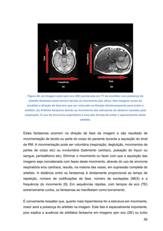 56
Figura 46. (a) Imagem axial spin eco (SE) ponderada em T1 do encéfalo com presença de
artefato fantasma (seta menor) devido ao movimento dos olhos. Nas imagens axiais do
encéfalo a direção de fase tem que ser colocada na direção direita-esquerda para evitar o
artefato. (b) Artefato fantasma devido ao movimento das estruturas do abdome causado pela
respiração. O uso de sincronia respiratória é uma das formas de evitar o aparecimento deste
artefato.
Estes fantasmas ocorrem na direção de fase da imagem e são resultado de
movimentação de tecido ou parte do corpo do paciente durante a aquisição do sinal
de RM. A movimentação pode ser voluntária (respiração, deglutição, movimentos de
partes de corpo etc) ou involuntária (batimento cardíaco, pulsação do líquor ou
sangue, peristaltismo etc). Eliminar o movimento ou fazer com que a aquisição das
imagens seja concatenada com fases deste movimento, através do uso de sincronia
respiratória e/ou cardíaca, resulta, na maioria das vezes, em supressão completa do
artefato. A distância entre os fantasmas é diretamente proporcional ao tempo de
repetição, número de codificações de fase, número de excitações (NEX) e a
frequência do movimento [0]. Em sequências rápidas, com tempos de eco (TE)
extremamente curtos, os fantasmas se manifestam como borramento.
É conveniente ressaltar que, quanto mais hiperintensa for a estrutura em movimento,
maior será a presença do artefato na imagem. Este fato é especialmente importante,
pois explica a ausência de artefatos fantasma em imagens spin eco (SE) ou turbo
 