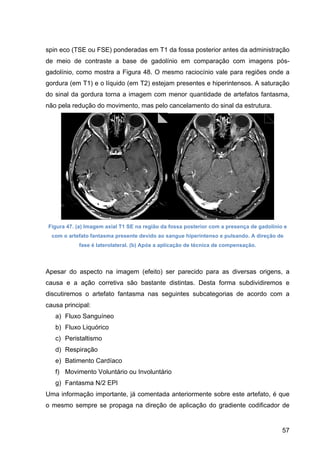 57
spin eco (TSE ou FSE) ponderadas em T1 da fossa posterior antes da administração
de meio de contraste a base de gadolínio em comparação com imagens pós-
gadolínio, como mostra a Figura 48. O mesmo raciocínio vale para regiões onde a
gordura (em T1) e o líquido (em T2) estejam presentes e hiperintensos. A saturação
do sinal da gordura torna a imagem com menor quantidade de artefatos fantasma,
não pela redução do movimento, mas pelo cancelamento do sinal da estrutura.
Figura 47. (a) Imagem axial T1 SE na região da fossa posterior com a presença de gadolínio e
com o artefato fantasma presente devido ao sangue hiperintenso e pulsando. A direção de
fase é laterolateral. (b) Após a aplicação de técnica de compensação.
Apesar do aspecto na imagem (efeito) ser parecido para as diversas origens, a
causa e a ação corretiva são bastante distintas. Desta forma subdividiremos e
discutiremos o artefato fantasma nas seguintes subcategorias de acordo com a
causa principal:
a) Fluxo Sanguíneo
b) Fluxo Liquórico
c) Peristaltismo
d) Respiração
e) Batimento Cardíaco
f) Movimento Voluntário ou Involuntário
g) Fantasma N/2 EPI
Uma informação importante, já comentada anteriormente sobre este artefato, é que
o mesmo sempre se propaga na direção de aplicação do gradiente codificador de
 