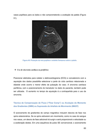 60
vasos poplíteos para os lados e não comprometendo a avaliação da patela (Figura
51).
Figura 49. Pulsação da veia poplítea e artefato fantasma sobre a patela.
v Uso de sincronia cardíaca ou periférica
Posicionar eletrodos para coletar o eletrocardiograma (ECG) e concatená-lo com a
aquisição dos dados possibilita selecionar a parte do ciclo cardíaco relacionada a
diástole onde ocorre o menor efeito de pulsação do vaso. A sincronia cardíaca
periférica, com o posicionamento do transdutor no dedo do paciente, também pode
ser utilizada. O aumento no tempo de aquisição é a contrapartida para o uso da
sincronia.
Técnica de Compensação de Fluxo (“Flow Comp”) ou Anulação do Momento
dos Gradientes (GMN) ou Supressão do Artefato de Movimento (MAST)
O acionamento de gradientes de campo magnético induzem desvios de fase nos
spins estacionários. Se os spins estiverem em movimento, como no caso do sangue
nos vasos, um desvio de fase adicional irá surgir e será proporcional a velocidade ou
a aceleração destes. Em uma sequência de pulso SE convencional, o acionamento
 
