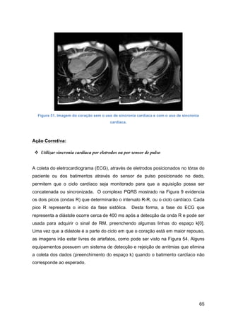 65
Figura 51. Imagem do coração sem o uso de sincronia cardíaca e com o uso de sincronia
cardíaca.
Ação Corretiva:
v Utilizar sincronia cardíaca por eletrodos ou por sensor de pulso
A coleta do eletrocardiograma (ECG), através de eletrodos posicionados no tórax do
paciente ou dos batimentos através do sensor de pulso posicionado no dedo,
permitem que o ciclo cardíaco seja monitorado para que a aquisição possa ser
concatenada ou sincronizada. O complexo PQRS mostrado na Figura 9 evidencia
os dois picos (ondas R) que determinarão o intervalo R-R, ou o ciclo cardíaco. Cada
pico R representa o início da fase sistólica. Desta forma, a fase do ECG que
representa a diástole ocorre cerca de 400 ms após a detecção da onda R e pode ser
usada para adquirir o sinal de RM, preenchendo algumas linhas do espaço k[0].
Uma vez que a diástole é a parte do ciclo em que o coração está em maior repouso,
as imagens irão estar livres de artefatos, como pode ser visto na Figura 54. Alguns
equipamentos possuem um sistema de detecção e rejeição de arritmias que elimina
a coleta dos dados (preenchimento do espaço k) quando o batimento cardíaco não
corresponde ao esperado.
 