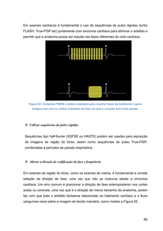 66
Em exames cardíacos é fundamental o uso de sequências de pulso rápidas (turbo
FLASH, True-FISP etc) juntamente com sincronia cardíaca para eliminar o artefato e
permitir que a anatomia possa ser estuda nas fases diferentes do ciclo cardíaco.
Figura 52. Complexo PQRS e dados coletados para mostrar fases do batimento e gerar
imagens em cine ou dados coletados da fase em que o coração está mais parado.
v Utilizar sequências de pulso rápidas
Sequências tipo half-fourier (SSFSE ou HASTE) podem ser usadas para aquisição
de imagens da região do tórax, assim como sequências de pulso True-FISP,
combinadas a períodos de parada respiratória.
v Alterar a direção de codificação de fase e frequência
Em exames da região do tórax, como os exames de mama, é fundamental a correta
seleção da direção de fase, uma vez que não se costuma adotar a sincronia
cardíaca. Um erro comum é posicionar a direção de fase anteroposterior nos cortes
axiais ou coronais, uma vez que é a direção de menor tamanho da anatomia, porém
faz com que todo o artefato fantasma relacionado ao batimento cardíaco e o fluxo
sanguíneo recai sobre a imagem do tecido mamário, como mostra a Figura 55.
 