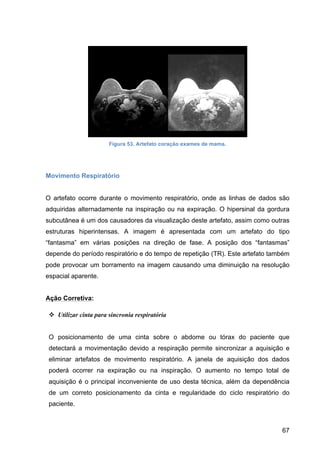 67
Figura 53. Artefato coração exames de mama.
Movimento Respiratório
O artefato ocorre durante o movimento respiratório, onde as linhas de dados são
adquiridas alternadamente na inspiração ou na expiração. O hipersinal da gordura
subcutânea é um dos causadores da visualização deste artefato, assim como outras
estruturas hiperintensas. A imagem é apresentada com um artefato do tipo
“fantasma” em várias posições na direção de fase. A posição dos “fantasmas”
depende do período respiratório e do tempo de repetição (TR). Este artefato também
pode provocar um borramento na imagem causando uma diminuição na resolução
espacial aparente.
Ação Corretiva:
v Utilizar cinta para sincronia respiratória
O posicionamento de uma cinta sobre o abdome ou tórax do paciente que
detectará a movimentação devido a respiração permite sincronizar a aquisição e
eliminar artefatos de movimento respiratório. A janela de aquisição dos dados
poderá ocorrer na expiração ou na inspiração. O aumento no tempo total de
aquisição é o principal inconveniente de uso desta técnica, além da dependência
de um correto posicionamento da cinta e regularidade do ciclo respiratório do
paciente.
 