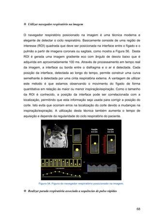 68
v Utilizar navegador respiratório na imagem
O navegador respiratório posicionado na imagem é uma técnica moderna e
elegante de detectar o ciclo respiratório. Basicamente consiste de uma região de
interesse (ROI) quadrada que deve ser posicionada na interface entre o fígado e o
pulmão a partir de imagens coronais ou sagitais, como mostra a Figura 56. Desta
ROI é gerada uma imagem gradiente eco com ângulo de desvio baixo que é
adquirida em aproximadamente 100 ms. Através de processamento em tempo real
da imagem, a interface ou borda entre o diafragma e o ar é detectada. Cada
posição da interface, detectada ao longo do tempo, permite construir uma curva
semelhante à detectada por uma cinta respiratória externa. A vantagem de utilizar
este método é que estamos observando o movimento do fígado de forma
quantitativa em relação às maior ou menor inspiração/expiração. Como o tamanho
da ROI é conhecido, a posição da interface pode ser correlacionada com a
localização, permitindo que esta informação seja usada para corrigir a posição do
corte. Isto evita que ocorram erros na localização do corte devido a mudanças na
inspiração/expiração. A utilização desta técnica também aumenta o tempo de
aquisição e depende da regularidade do ciclo respiratório do paciente.
Figura 54. Figura do navegador respiratório posicionado na imagem.
v Realizar parada respiratória associada a sequências de pulso rápidas
 