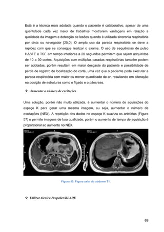 69
Está é a técnica mais adotada quando o paciente é colaborativo, apesar de uma
quantidade cada vez maior de trabalhos mostrarem vantagens em relação a
qualidade da imagem e detecção de lesões quando é utilizada sincronia respiratória
por cinta ou navegador [25,0]. O amplo uso da parada respiratória se deve a
rapidez com que se consegue realizar o exame. O uso de sequências de pulso
HASTE e TSE em tempo inferiores a 20 segundos permitem que sejam adquiridos
de 10 a 30 cortes. Aquisições com múltiplas paradas respiratórias também podem
ser adotadas, porém resultam em maior desgaste do paciente e possibilidade de
perda de registro de localização do corte, uma vez que o paciente pode executar a
parada respiratória com maior ou menor quantidade de ar, resultando em alteração
na posição de estruturas como o fígado e o pâncreas.
v Aumentar o número de excitações
Uma solução, porém não muito utilizada, é aumentar o número de aquisições do
espaço K para gerar uma mesma imagem, ou seja, aumentar o número de
excitações (NEX). A repetição dos dados no espaço K suaviza os artefatos (Figura
57) e permite imagens de boa qualidade, porém o aumento de tempo de aquisição é
proporcional ao aumento no NEX.
Figura 55. Figura axial do abdome T1.
v Utilizar técnica Propeller/BLADE
 
