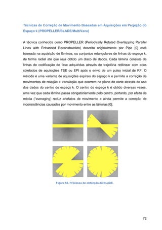 72
Técnicas de Correção de Movimento Baseadas em Aquisições em Projeção do
Espaço k (PROPELLER/BLADE/MultiVane)
A técnica conhecida como PROPELLER (Periodically Rotated Overlapping Parallel
Lines with Enhanced Reconstruction) descrita originalmente por Pipe [0] está
baseada na aquisição de lâminas, ou conjuntos retangulares de linhas do espaço k,
de forma radial até que seja obtido um disco de dados. Cada lâmina consiste de
linhas de codificação de fase adquiridas através de trajetória retilinear com ecos
coletados de aquisições TSE ou EPI após o envio de um pulso inicial de RF. O
método é uma variante de aquisições espirais do espaço k e permite a correção de
movimentos de rotação e translação que ocorrem no plano de corte através do uso
dos dados do centro do espaço k. O centro do espaço k é obtido diversas vezes,
uma vez que cada lâmina passa obrigatoriamente pelo centro, portanto, por efeito de
média (“averaging) reduz artefatos de movimento e ainda permite a correção de
inconsistências causadas por movimento entre as lâminas [0].
Figura 56. Processo de obtenção do BLADE.
 