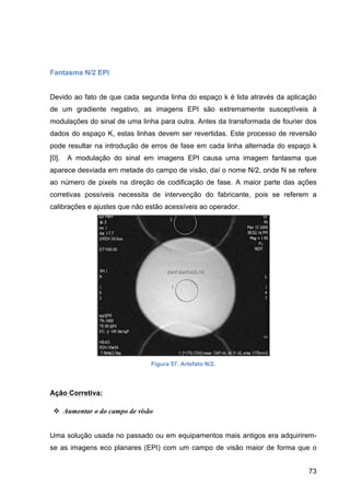 73
Fantasma N/2 EPI
Devido ao fato de que cada segunda linha do espaço k é lida através da aplicação
de um gradiente negativo, as imagens EPI são extremamente susceptíveis à
modulações do sinal de uma linha para outra. Antes da transformada de fourier dos
dados do espaço K, estas linhas devem ser revertidas. Este processo de reversão
pode resultar na introdução de erros de fase em cada linha alternada do espaço k
[0]. A modulação do sinal em imagens EPI causa uma imagem fantasma que
aparece desviada em metade do campo de visão, daí o nome N/2, onde N se refere
ao número de pixels na direção de codificação de fase. A maior parte das ações
corretivas possíveis necessita de intervenção do fabricante, pois se referem a
calibrações e ajustes que não estão acessíveis ao operador.
Figura 57. Artefato N/2.
Ação Corretiva:
v Aumentar o do campo de visão
Uma solução usada no passado ou em equipamentos mais antigos era adquirirem-
se as imagens eco planares (EPI) com um campo de visão maior de forma que o
 
