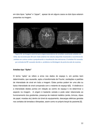 77
em dois tipos: “spikes” e “zipper”, apesar de em alguns casos os dois tipos estarem
presentes na imagem.
Figura 59. (a) Imagem axial tof para angiorressonância do encéfalo mostrando artefato em
linha. (b) reconstrução 3D com visão anterior do volume adquirido mostrando a ocorrência do
artefato em outros cortes e prejudicando a visualizacão das estruturas. O artefato foi causado
por entrada de RF causado devido a problema na blindagem da porta da sala de exames.
Artefato tipo “Spike”
O termo “spike” se refere a erros nos dados do espaço k, em pontos bem
determinados, que causarão, após a transformada de Fourier, oscilações e padrões
de intensidade de sinal em toda a imagem. Estes pontos podem ter uma alta ou
baixa intensidade de sinal comparada com o restante do espaço k[0]. A distância e
a intensidade destes pontos em relação ao centro do espaço k irá determinar o
aspecto na imagem. A origem é bastante variada e pode estar relacionada ao
funcionamento dos gradientes, presença de material metálico (anéis, brincos, clipes
de papel, moedas etc) dentro do túnel do equipamento, descargas elétricas geradas
nos contatos de tomadas e lâmpadas, assim como no próprio lençol do paciente [0].
 
