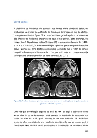 81
Desvio Químico
A presença de contornos ou sombras nos limites entre diferentes estruturas
anatômicas na direção de codificação de frequência denúncia este tipo de artefato,
como pode ser visto na Figura 65. A causa é a diferença na frequência de precessão
dos prótons de hidrogênio presentes na água e na gordura. Esta diferença, ou
desvio, é de 3,35 partes por milhão (3,35 ppm)[0], o que representa cerca de 214 Hz
a 1,5 T e 428 Hz a 3,0T. Com este exemplo é possível perceber que o artefato de
desvio químico se torna bastante pronunciado à medida que o valor do campo
magnético dos equipamentos aumenta, o que, por outro lado, faz com que não seja
tão importante em equipamentos de baixo campo (0,2 a 0,5T).
Figura 62. Artefato de desvio químico criando uma falsa borda na direção de frequência entre a
gordura e o tecido hepático.
Uma vez que a codificação espacial do sinal de RM - ou seja, a posição de onde
vem o sinal do corpo do paciente - está baseada na frequência de precessão, um
tecido ao lado do outro (pixel vizinho) irá ter uma distância em milímetros
proporcional a uma distância em frequência, considerando que os tecidos dentro
destes dois pixels vizinhos sejam iguais quanto a composição. Já, se a composição
 