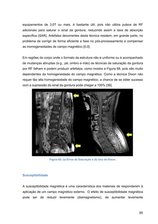 85
equipamentos de 3,0T ou mais, é bastante útil, pois não utiliza pulsos de RF
adicionais para saturar o sinal da gordura, reduzindo assim a taxa de absorção
específica (SAR). Artefatos decorrentes desta técnica residem, em grande parte, no
problema de corrigir de forma eficiente a fase no pós-processamento e compensar
as inomogeneidades de campo magnético [0,0].
Em regiões do corpo onde o formato da estrutura não é uniforme ou é acompanhado
de mudanças abruptas (e.g., pé, ombro e mão) as técnicas de saturação da gordura
por RF falham e podem produzir artefatos, como mostra a Figura 68, pois são muito
dependentes da homogeneidade do campo magnético. Como a técnica Dixon não
requer tão alta homogeneidade do campo magnético, a chance de se obter sucesso
com a supressão do sinal da gordura pode chegar a 100% [36].
Figura 65. (a) Erros de Saturação e (b) Uso do Dixon.
Susceptibilidade
A susceptibilidade magnética é uma característica dos materiais de responderem à
aplicação de um campo magnético externo. O efeito de susceptibilidade magnética
pode ser de reduzir levemente (diamagnetismo), de aumentar levemente
 