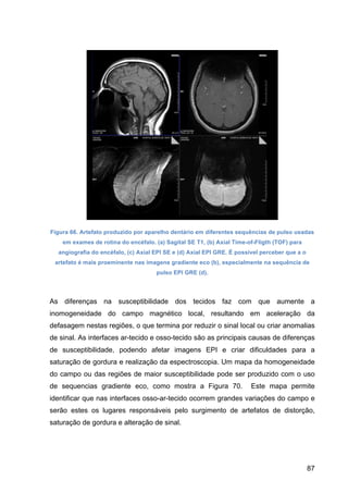 87
Figura 66. Artefato produzido por aparelho dentário em diferentes sequências de pulso usadas
em exames de rotina do encéfalo. (a) Sagital SE T1, (b) Axial Time-of-Fligth (TOF) para
angiografia do encéfalo, (c) Axial EPI SE e (d) Axial EPI GRE. É possível perceber que a o
artefato é mais proeminente nas imagens gradiente eco (b), especialmente na sequência de
pulso EPI GRE (d).
As diferenças na susceptibilidade dos tecidos faz com que aumente a
inomogeneidade do campo magnético local, resultando em aceleração da
defasagem nestas regiões, o que termina por reduzir o sinal local ou criar anomalias
de sinal. As interfaces ar-tecido e osso-tecido são as principais causas de diferenças
de susceptibilidade, podendo afetar imagens EPI e criar dificuldades para a
saturação de gordura e realização da espectroscopia. Um mapa da homogeneidade
do campo ou das regiões de maior susceptibilidade pode ser produzido com o uso
de sequencias gradiente eco, como mostra a Figura 70. Este mapa permite
identificar que nas interfaces osso-ar-tecido ocorrem grandes variações do campo e
serão estes os lugares responsáveis pelo surgimento de artefatos de distorção,
saturação de gordura e alteração de sinal.
 