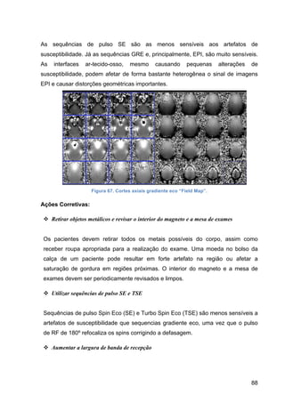 88
As sequências de pulso SE são as menos sensíveis aos artefatos de
susceptibilidade. Já as sequências GRE e, principalmente, EPI, são muito sensíveis.
As interfaces ar-tecido-osso, mesmo causando pequenas alterações de
susceptibilidade, podem afetar de forma bastante heterogênea o sinal de imagens
EPI e causar distorções geométricas importantes.
Figura 67. Cortes axiais gradiente eco “Field Map”.
Ações Corretivas:
v Retirar objetos metálicos e revisar o interior do magneto e a mesa de exames
Os pacientes devem retirar todos os metais possíveis do corpo, assim como
receber roupa apropriada para a realização do exame. Uma moeda no bolso da
calça de um paciente pode resultar em forte artefato na região ou afetar a
saturação de gordura em regiões próximas. O interior do magneto e a mesa de
exames devem ser periodicamente revisados e limpos.
v Utilizar sequências de pulso SE e TSE
Sequências de pulso Spin Eco (SE) e Turbo Spin Eco (TSE) são menos sensíveis a
artefatos de susceptibilidade que sequencias gradiente eco, uma vez que o pulso
de RF de 180º refocaliza os spins corrigindo a defasagem.
v Aumentar a largura de banda de recepção
 