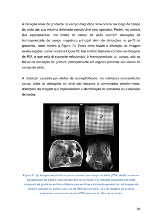 95
A variação linear do gradiente de campo magnético deve ocorrer ao longo do campo
de visão até sua máxima dimensão selecionável pelo operador. Porém, na maioria
dos equipamentos, nos limites do campo de visão ocorrem alterações da
homogeneidade de campo magnético principal além de distorções no perfil do
gradiente, como mostra a Figura 73. Estes erros levam a distorção da imagem
nestas regiões, como mostra a Figura 70. Um artefato bastante comum nas imagens
de RM, e que está diretamente relacionado à homogeneidade do campo, são as
falhas na saturação de gordura, principalmente em regiões próximas aos limites do
campo de visão.
A distorção causada por efeitos de susceptibilidade das interfaces ar-osso-tecido
causa, além de alterações no sinal das imagens já comentadas anteriormente,
distorções da imagem que impossibilitam a identificação de estruturas ou a medição
de lesões.
Figura 71. (a) Imagem adquirida no plano coronal com campo de visão (CDV) de 40 cm em um
equipamento de 0,35T e sem uso do filtro de correção. Foi utilizado dispositivo de teste
composto de grade de acrílico utilizado para verificar a distorção geométrica. (a) Imagem do
mesmo dispositivo, porém com uso do filtro de correção. (c) e (d) Imagens de exames
realizados com uso do máximo CDV sem uso do filtro de correção.
 