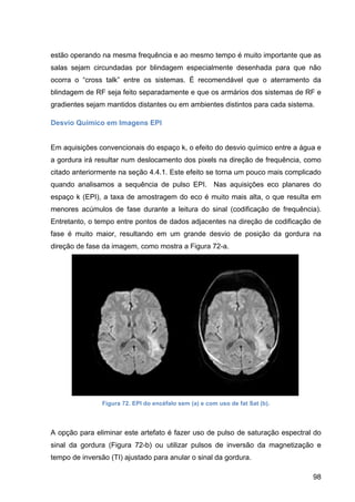 98
estão operando na mesma frequência e ao mesmo tempo é muito importante que as
salas sejam circundadas por blindagem especialmente desenhada para que não
ocorra o “cross talk” entre os sistemas. É recomendável que o aterramento da
blindagem de RF seja feito separadamente e que os armários dos sistemas de RF e
gradientes sejam mantidos distantes ou em ambientes distintos para cada sistema.
Desvio Químico em Imagens EPI
Em aquisições convencionais do espaço k, o efeito do desvio químico entre a água e
a gordura irá resultar num deslocamento dos pixels na direção de frequência, como
citado anteriormente na seção 4.4.1. Este efeito se torna um pouco mais complicado
quando analisamos a sequência de pulso EPI. Nas aquisições eco planares do
espaço k (EPI), a taxa de amostragem do eco é muito mais alta, o que resulta em
menores acúmulos de fase durante a leitura do sinal (codificação de frequência).
Entretanto, o tempo entre pontos de dados adjacentes na direção de codificação de
fase é muito maior, resultando em um grande desvio de posição da gordura na
direção de fase da imagem, como mostra a Figura 72-a.
Figura 72. EPI do encéfalo sem (a) e com uso de fat Sat (b).
A opção para eliminar este artefato é fazer uso de pulso de saturação espectral do
sinal da gordura (Figura 72-b) ou utilizar pulsos de inversão da magnetização e
tempo de inversão (TI) ajustado para anular o sinal da gordura.
 