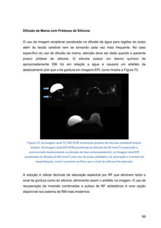 99
Difusão da Mama com Próteses de Silicone
O uso da imagem ecoplanar ponderada na difusão da água para regiões do corpo
além do tecido cerebral vem se tornando cada vez mais frequente. No caso
específico do uso de difusão da mama, atenção deve ser dada quando a paciente
possui prótese de silicone. O silicone possui um desvio químico de
aproximadamente 296 Hz em relação a água e causará um artefato de
deslocamento pior que o da gordura em imagens EPI, como mostra a Figura 73.
Figura 73. (a) Imagem axial T2 TSE STIR mostrando prótese de silicone unilateral (mama
direita). (b) Imagem axial EPI STIR ponderada na difusão (b=50 mm/s
2
) mostrando o
pronunciado deslocamento na direção de fase (anteroposterior). (c) Imagem axial EPI
ponderada na difusão (b=50 mm/s
2
) com uso de pulso adiabático de saturação e inversão da
magnetização, onde é possível verificar que o sinal do silicone foi saturado.
A solução é utilizar técnicas de saturação espectral por RF que eliminem tanto o
sinal da gordura como do silicone, eliminando assim o artefato na imagem. O uso de
recuperação da inversão combinadas a pulsos de RF adiabáticos é uma opção
disponível nos sistema de RM mais modernos.
 