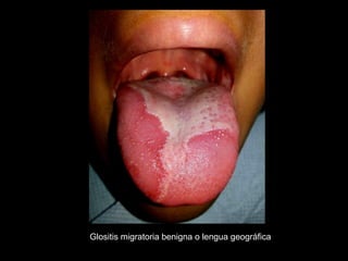 Glositis migratoria benigna o lengua geográfica
 