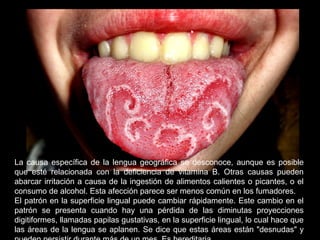 -
La causa específica de la lengua geográfica se desconoce, aunque es posible
que esté relacionada con la deficiencia de vitamina B. Otras causas pueden
abarcar irritación a causa de la ingestión de alimentos calientes o picantes, o el
consumo de alcohol. Esta afección parece ser menos común en los fumadores.
El patrón en la superficie lingual puede cambiar rápidamente. Este cambio en el
patrón se presenta cuando hay una pérdida de las diminutas proyecciones
digitiformes, llamadas papilas gustativas, en la superficie lingual, lo cual hace que
las áreas de la lengua se aplanen. Se dice que estas áreas están "desnudas" y
 