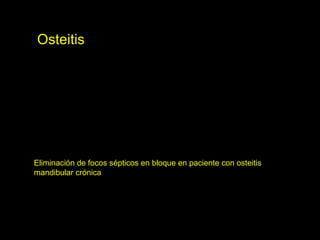 Eliminación de focos sépticos en bloque en paciente con osteitis
mandibular crónica
Osteitis
 