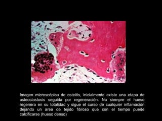 Imagen microscópica de osteitis, inicialmente existe una etapa de
osteoclastosis seguida por regeneración. No siempre el hueso
regenera en su totalidad y sigue el curso de cualquier inflamación
dejando un area de tejido fibroso que con el tiempo puede
calcificarse (hueso denso)
 