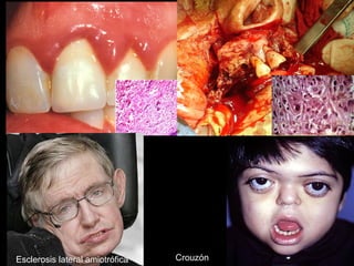 Esclerosis lateral amiotrófica Crouzón
 