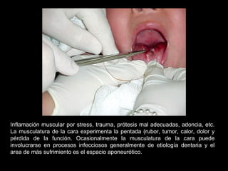 Inflamación muscular por stress, trauma, prótesis mal adecuadas, adoncia, etc.
La musculatura de la cara experimenta la pentada (rubor, tumor, calor, dolor y
pérdida de la función. Ocasionalmente la musculatura de la cara puede
involucrarse en procesos infecciosos generalmente de etiología dentaria y el
area de más sufrimiento es el espacio aponeurótico.
 