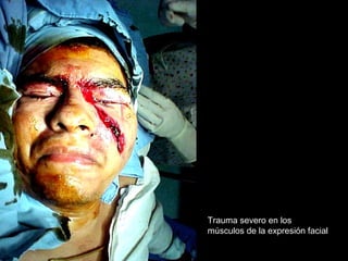 Trauma severo en los
músculos de la expresión facial
 