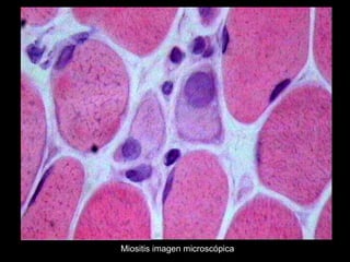 Miositis imagen microscópica
 