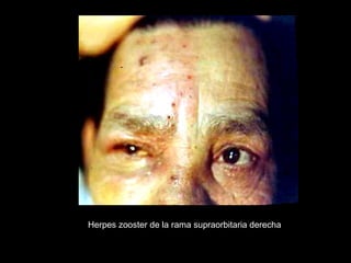Herpes zooster de la rama supraorbitaria derecha
 